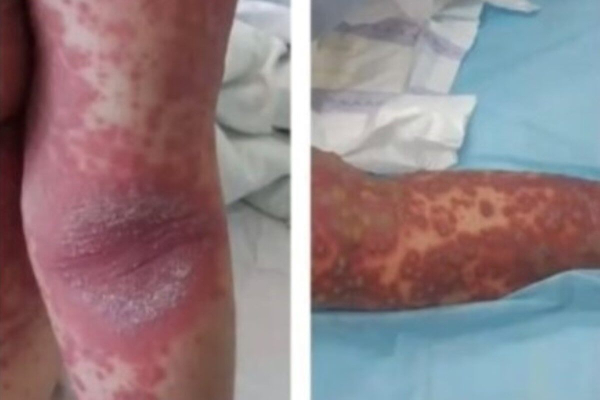 Из-за аллергии на неизвестные препараты жительница Шымкента попала в реанимацию